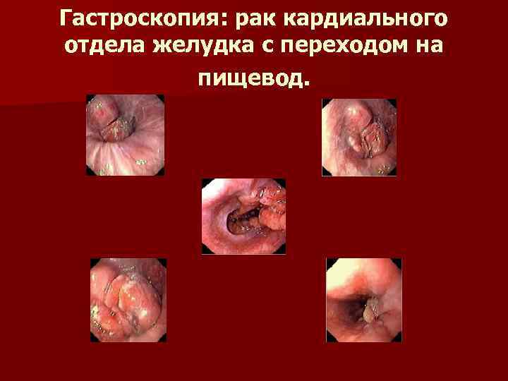 Гастроскопия: рак кардиального отдела желудка с переходом на пищевод. 