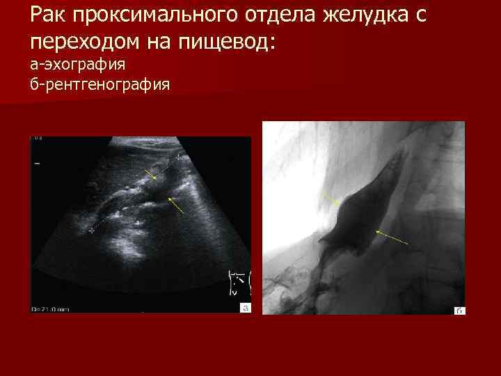 Рак проксимального отдела желудка с переходом на пищевод: а-эхография б-рентгенография 