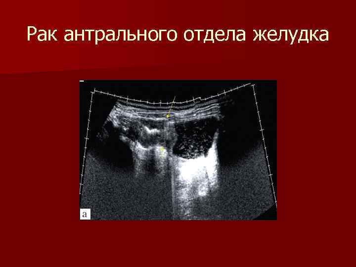 Рак антрального отдела желудка 