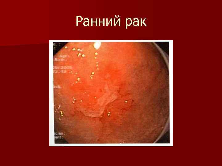 Ранний рак 