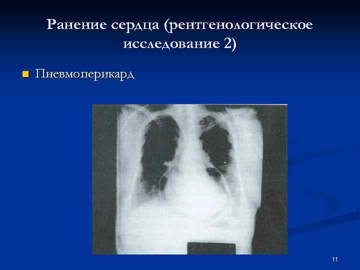 Ранение сердца (рентгенологическое исследование 2) n Пневмоперикард 11 