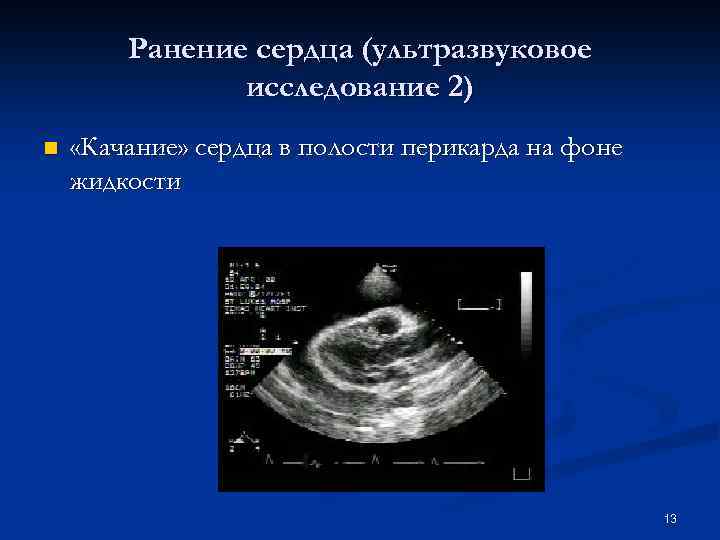 Ранение сердца (ультразвуковое исследование 2) n «Качание» сердца в полости перикарда на фоне жидкости