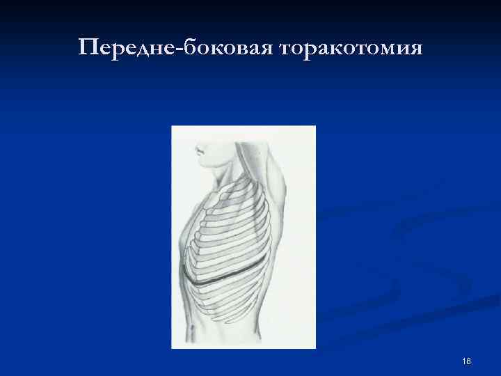 Передне-боковая торакотомия 16 