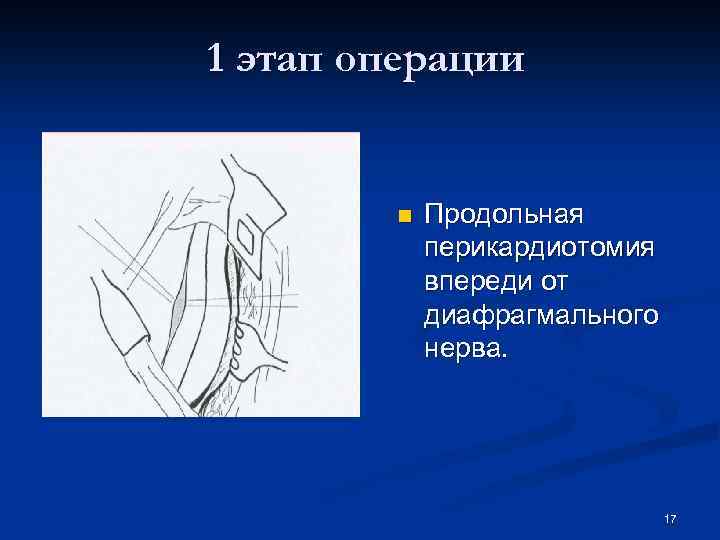 1 этап операции n Продольная перикардиотомия впереди от диафрагмального нерва. 17 