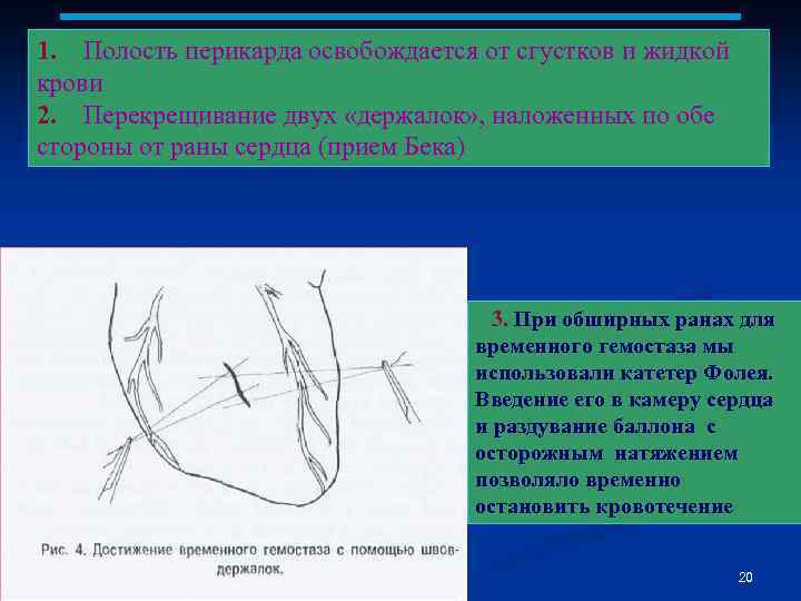 1. Полость перикарда освобождается от сгустков и жидкой крови 2. Перекрещивание двух «держалок» ,