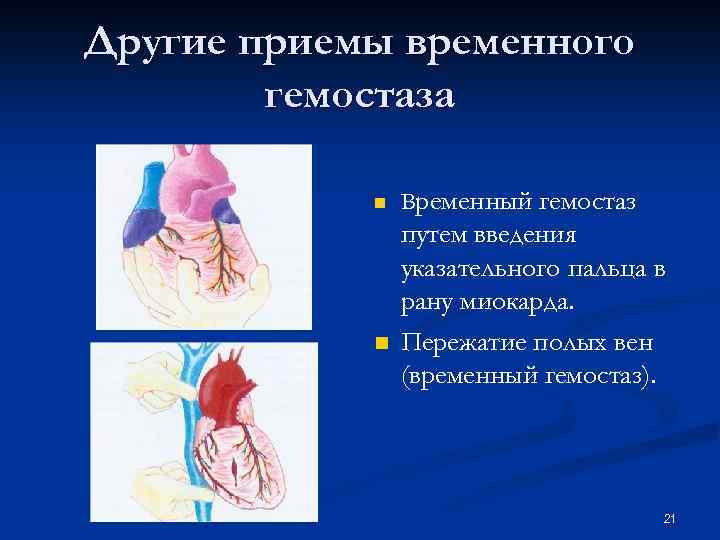Другие приемы временного гемостаза n n Временный гемостаз путем введения указательного пальца в рану