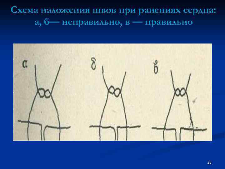 Схема наложения швов при ранениях сердца: а, б— неправильно, в — правильно 23 