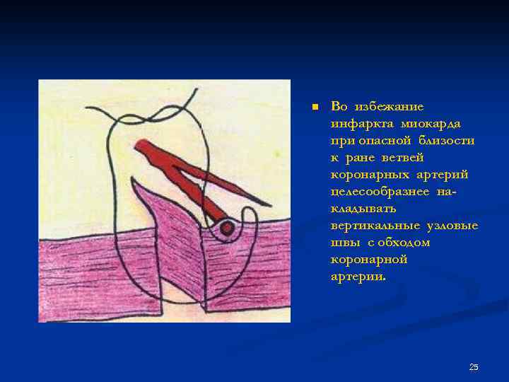 n Во избежание инфаркта миокарда при опасной близости к ране ветвей коронарных артерий целесообразнее