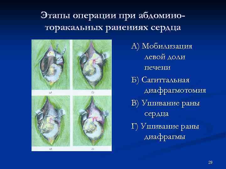 Этапы операции при абдоминоторакальных ранениях сердца А) Мобилизация левой доли печени Б) Сагиттальная диафрагмотомия