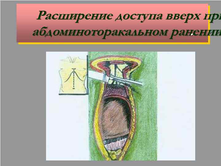 Расширение доступа вверх при абдоминоторакальном ранении. 30 