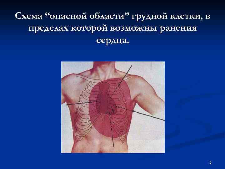 Схема “опасной области” грудной клетки, в пределах которой возможны ранения сердца. 5 