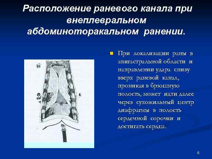 Расположение раневого канала при внеплевральном абдоминоторакальном ранении. n При локализации раны в эпигастральной области