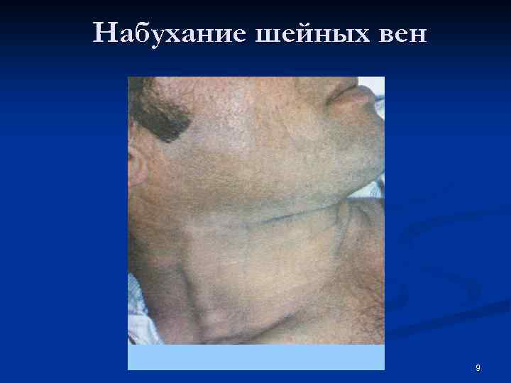 Набухание шейных вен 9 