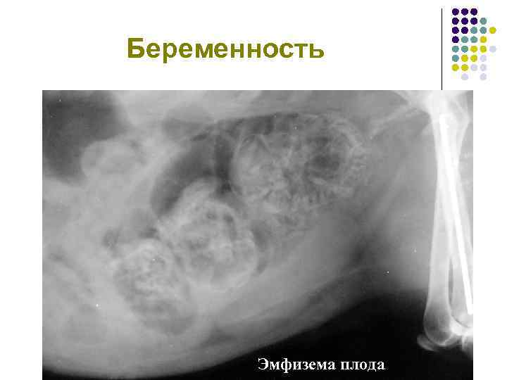 Беременность Эмфизема плода 