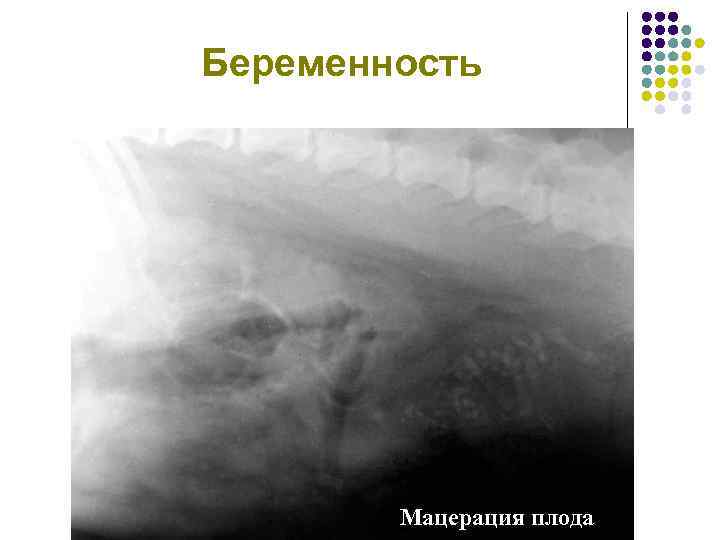 Беременность Мацерация плода 