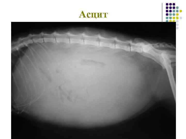 Асцит 