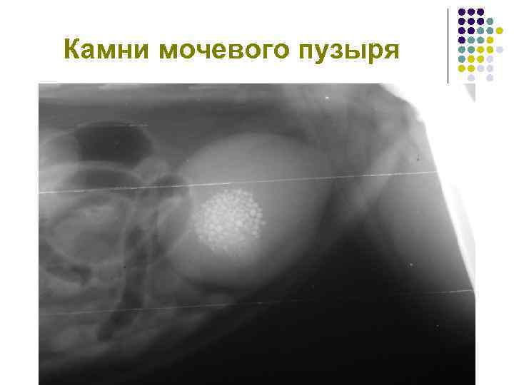 Камни мочевого пузыря 