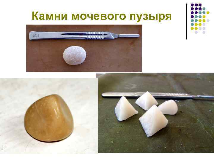 Камни мочевого пузыря 