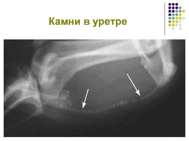 Камни в уретре 