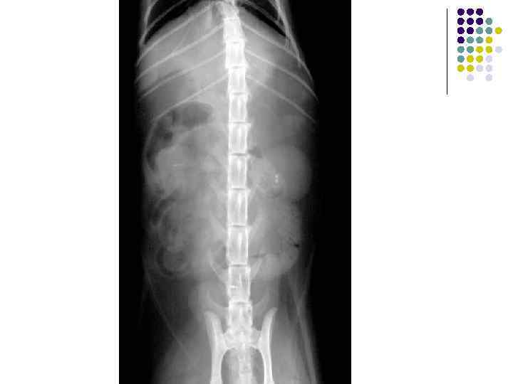 Камни почечной лоханки 