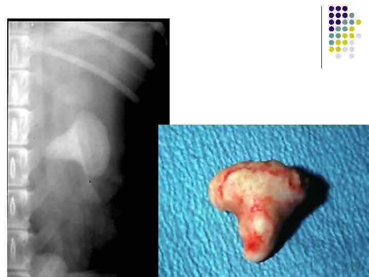 Камень почечной лоханки 