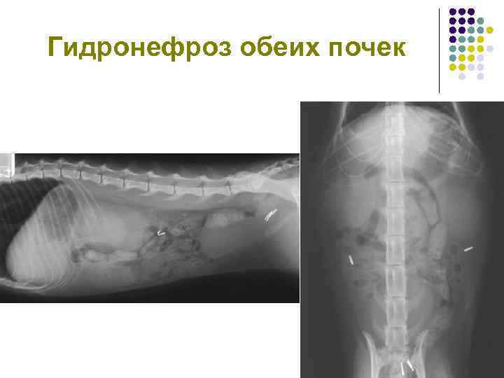 Гидронефроз обеих почек 
