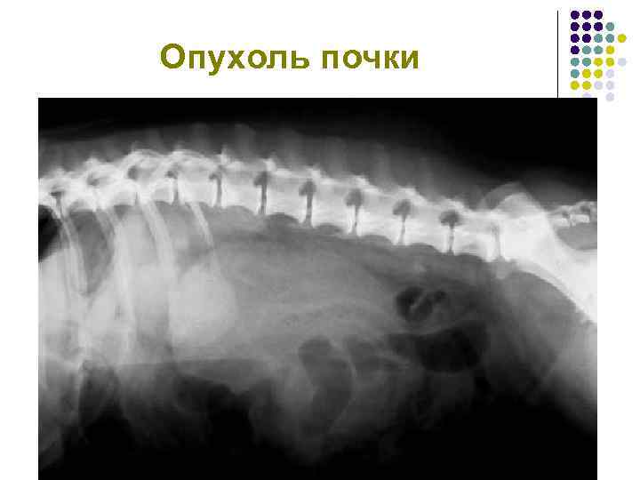 Опухоль почки 