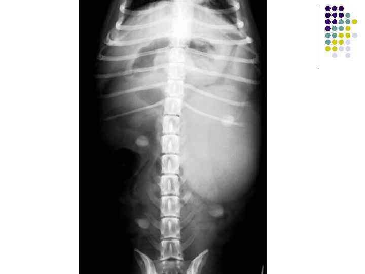 Опухоль почки 