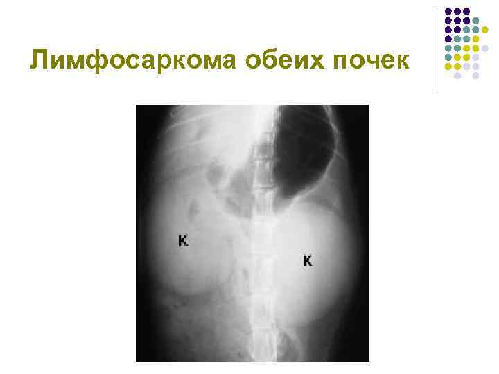 Лимфосаркома обеих почек 