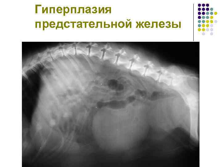 Гиперплазия предстательной железы 