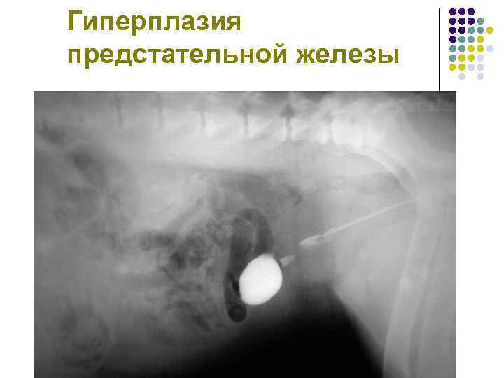 Гиперплазия предстательной железы 