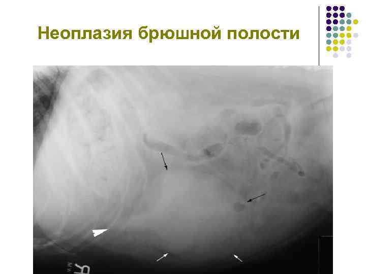 Неоплазия брюшной полости 