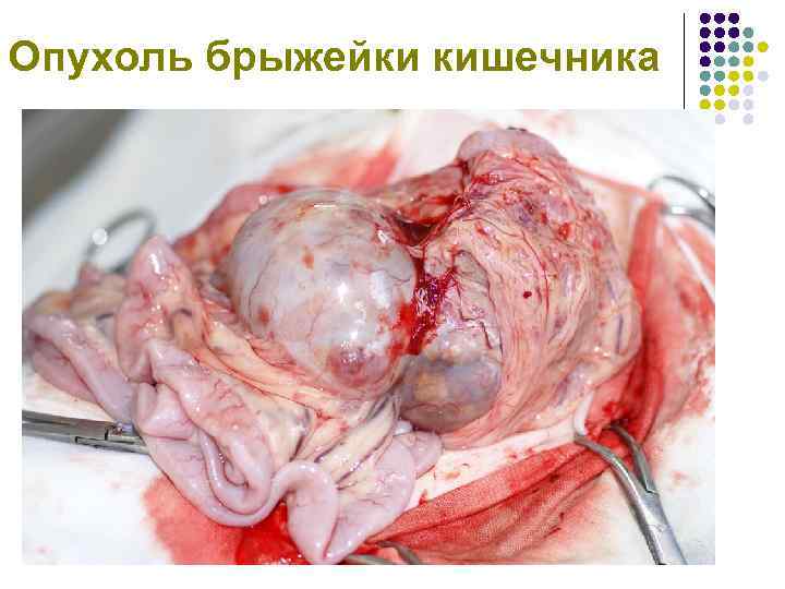 Опухоль брыжейки кишечника 