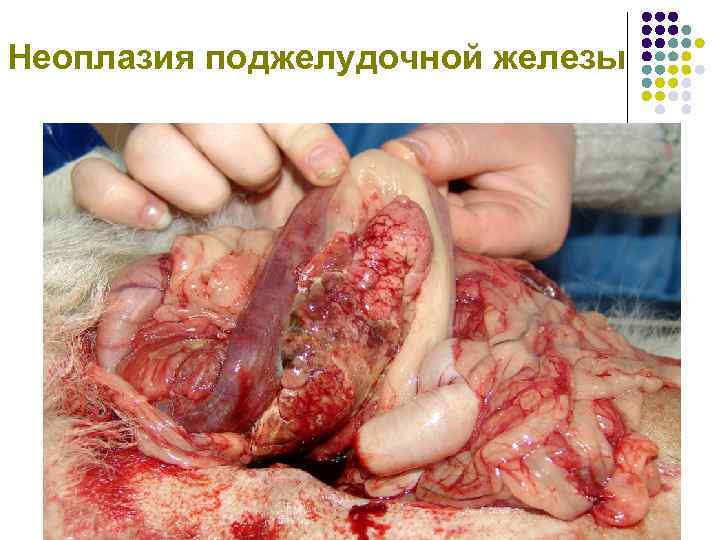 Неоплазия поджелудочной железы 