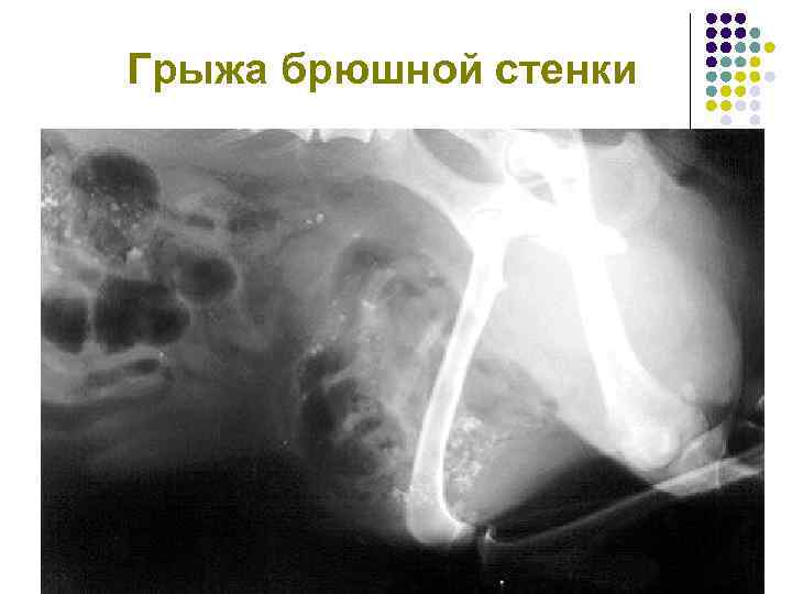 Грыжа брюшной стенки 