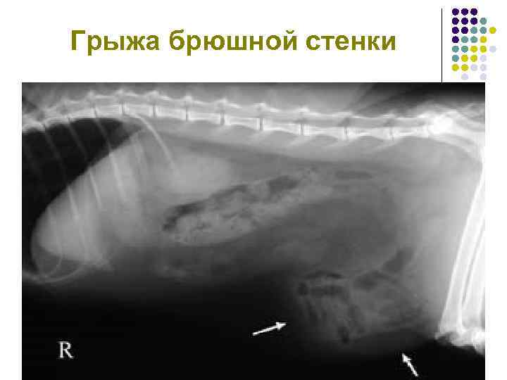 Грыжа брюшной стенки