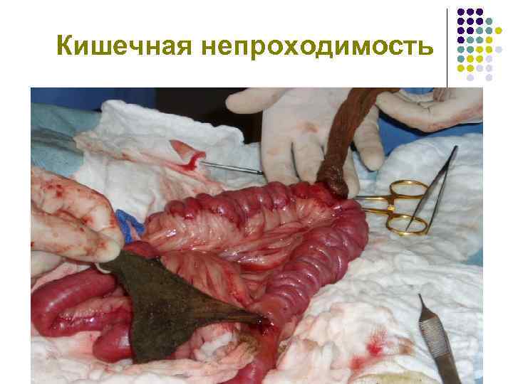 Кишечная непроходимость 