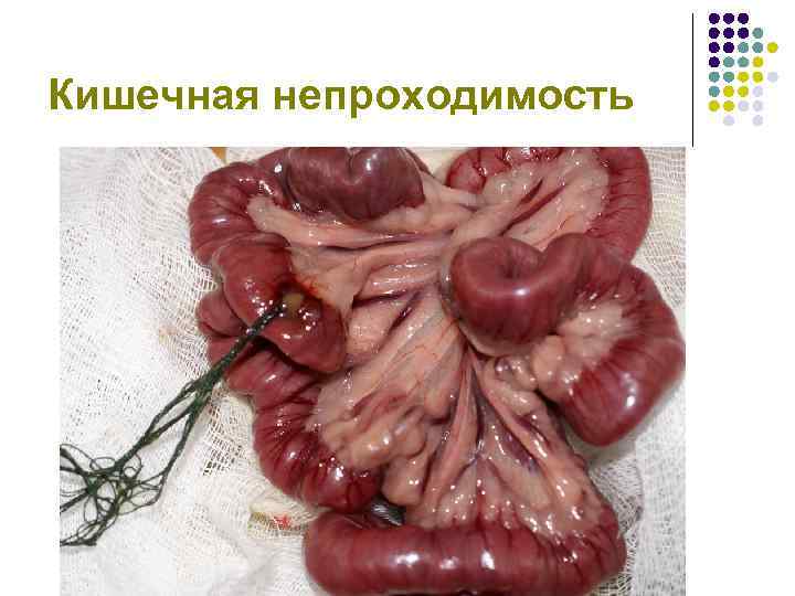 Кишечная непроходимость 