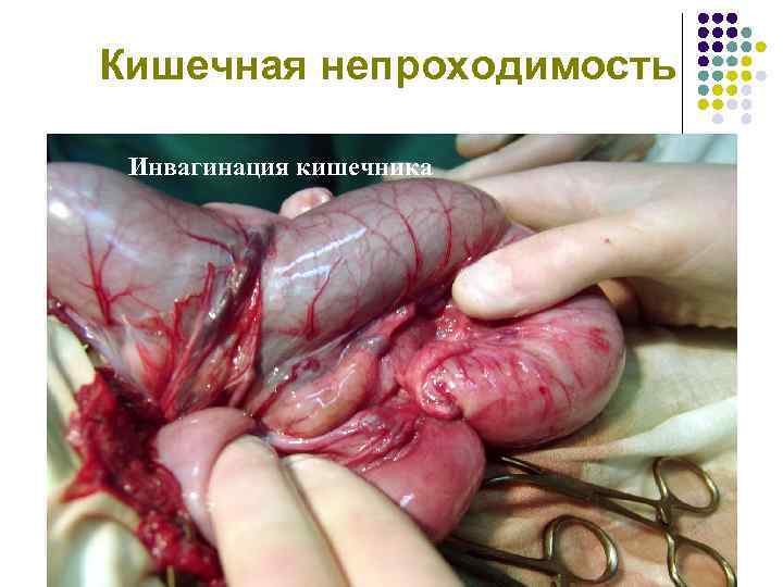 Кишечная непроходимость Инвагинация кишечника 