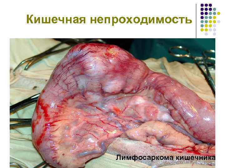 Кишечная непроходимость Лимфосаркома кишечника 