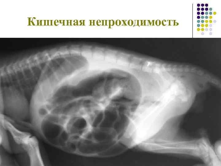 Кишечная непроходимость 