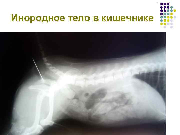 Инородное тело в кишечнике 