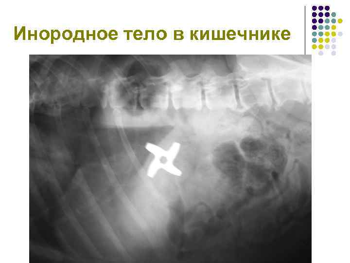 Инородное тело в кишечнике 