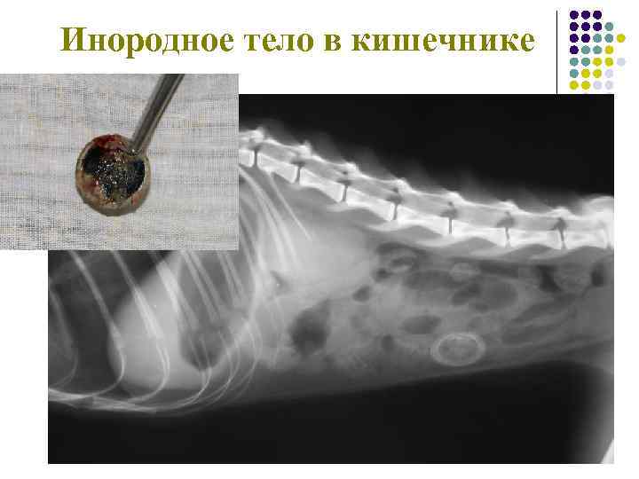 Инородное тело в кишечнике 