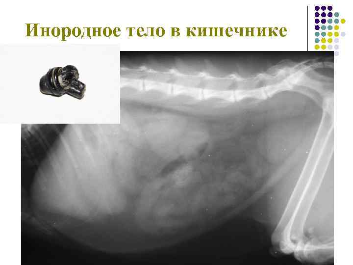 Инородное тело в кишечнике 