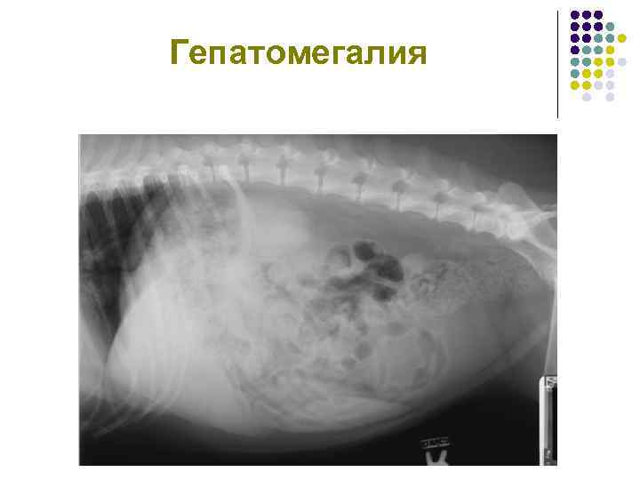 Гепатоза гепатомегалии