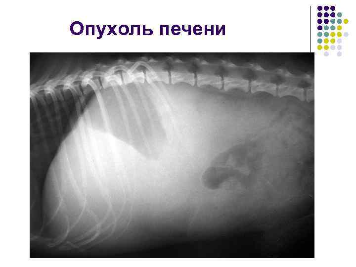 Опухоль печени 