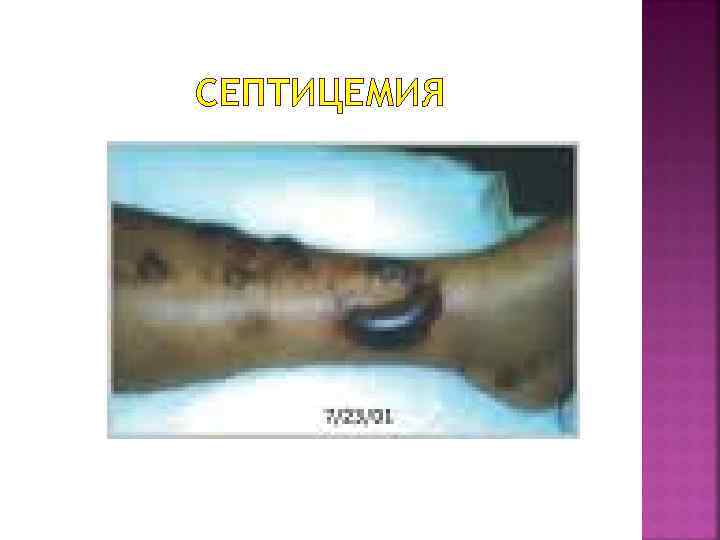 СЕПТИЦЕМИЯ 