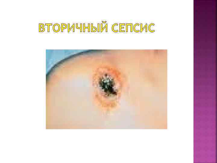 ВТОРИЧНЫЙ СЕПСИС 