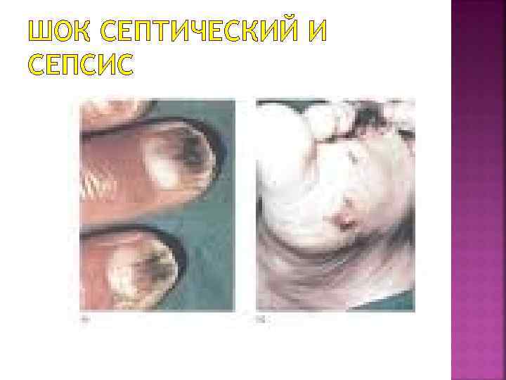 ШОК СЕПТИЧЕСКИЙ И СЕПСИС 